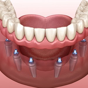 Illustration of implant dentures